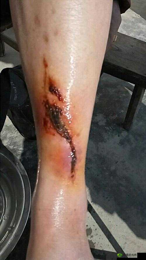 红肿疼痛小缝不能合拢:这是怎么了