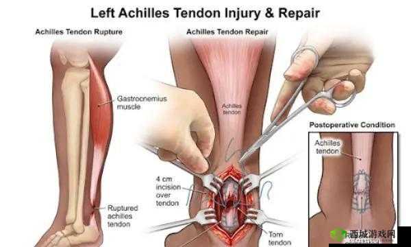 八爪鱼紧缩术能达到什么效果:深度解析