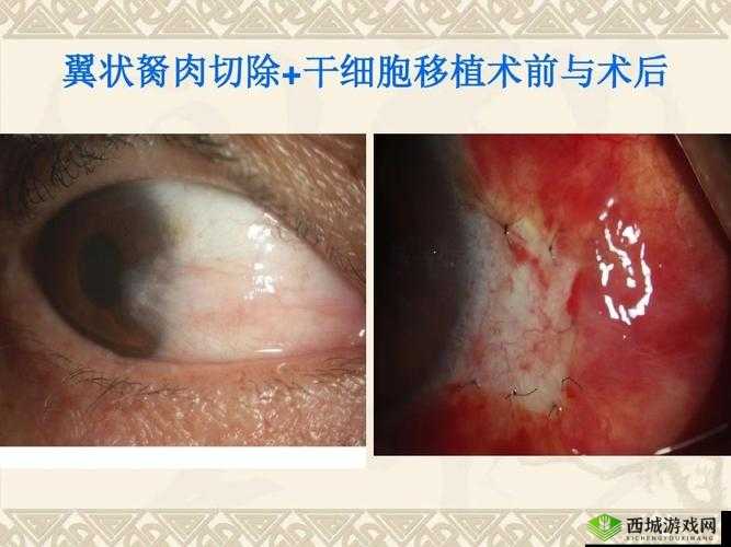 超级胬肉系统的创新应用与发展