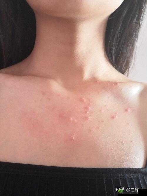 女生胸前长疙瘩，竟是因为这个