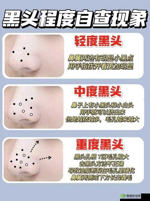 粗大黑头紫大黑头紫挤进:一场奇异的现象