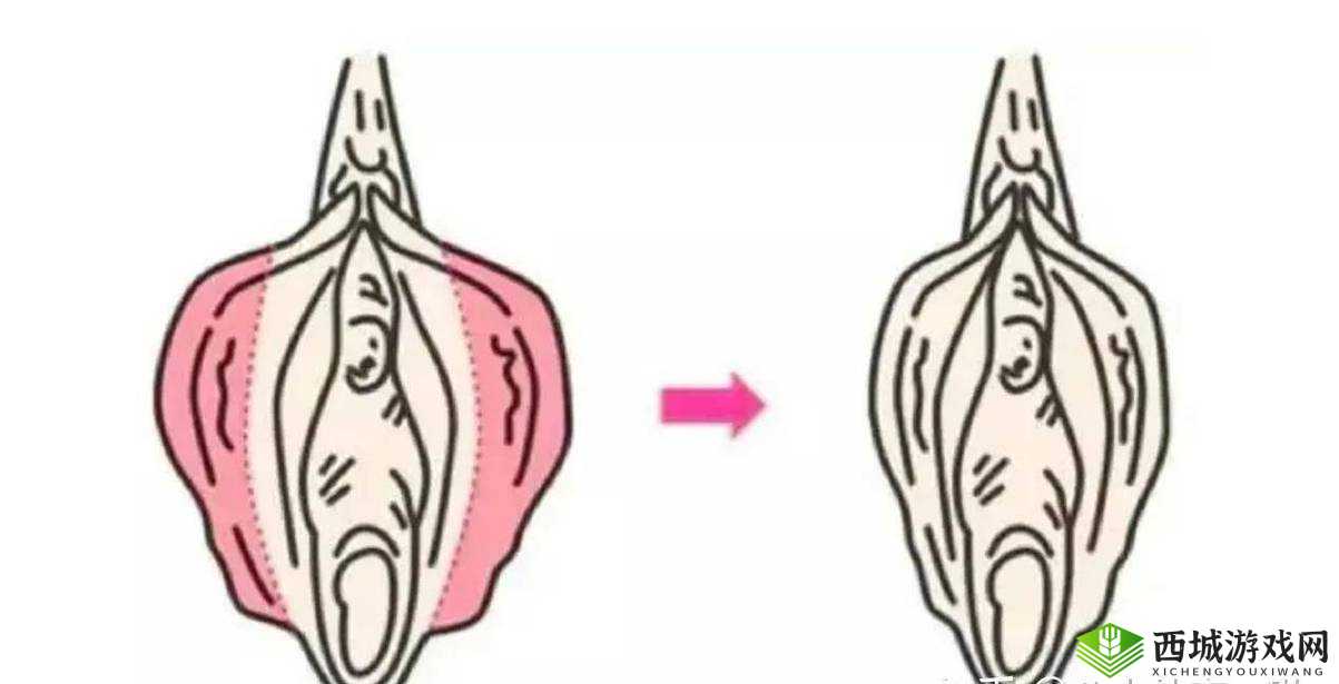 小阴天唇肥大整形有必要吗：专家解析
