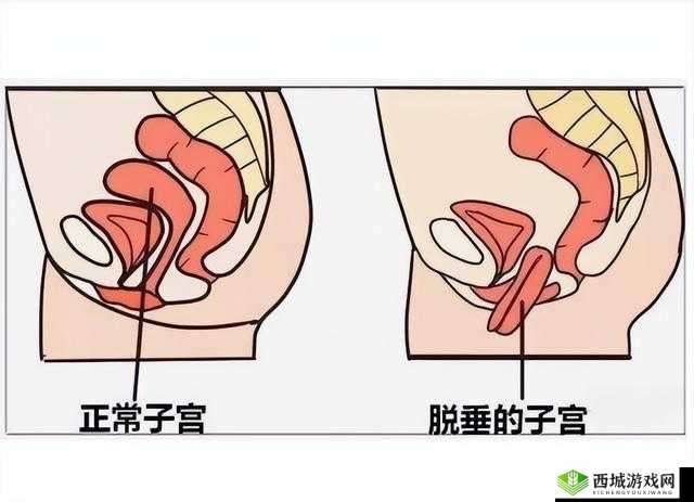 女性阴挺病：其发病原因究竟为何