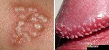 丁丁上长小白点像粉刺究竟是何原因引发的呢