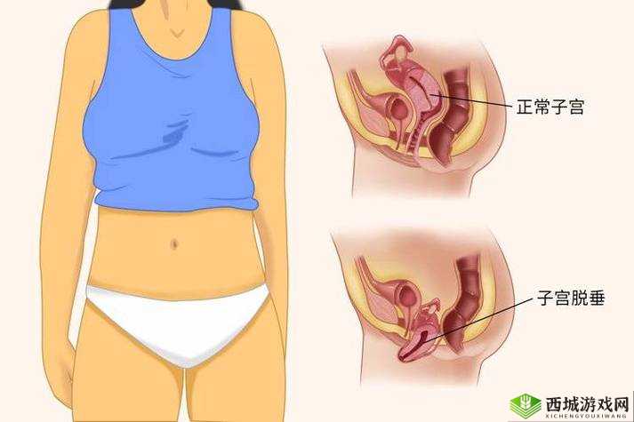 女性生殖系统疾病防治：阴挺病的原因及应对措施